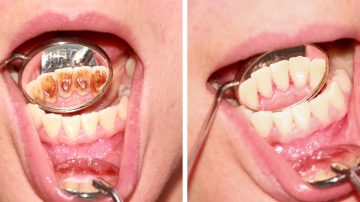 Tartar Before and After Dental Cleaning