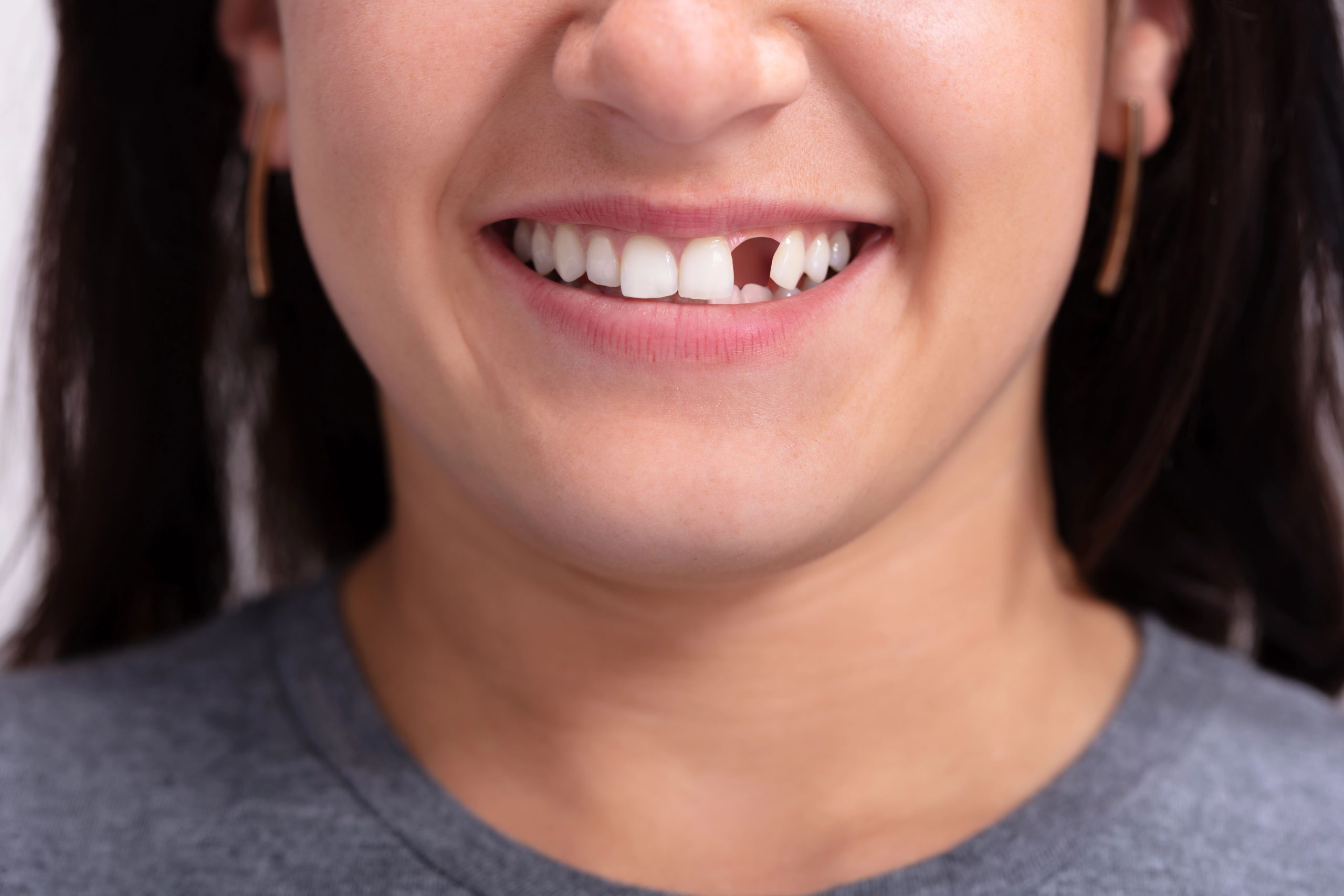 Explore What To Do for a Knocked-Out Tooth Emergency at Norwood Dental Cosmetics in Norwood, MA