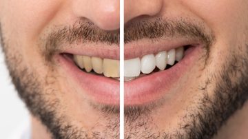 Teeth Whitening for Sensitive Teeth: Gentle Methods That Work