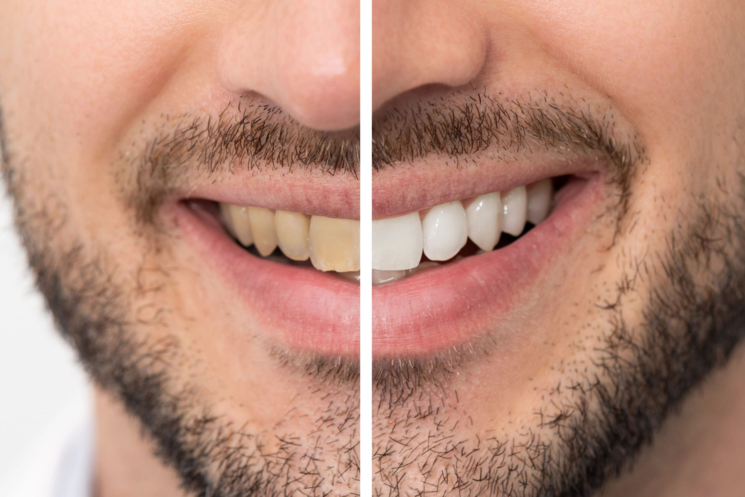 Teeth Whitening for Sensitive Teeth: Gentle Methods That Work
