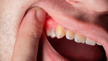 Dental Abscess Warning Signs and Essential Emergency Steps