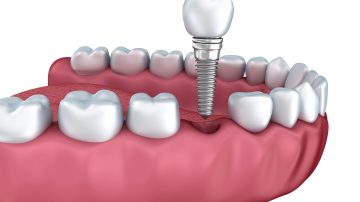 Dental Crown Without Metal: Aesthetic Solutions for a Seamless Smile