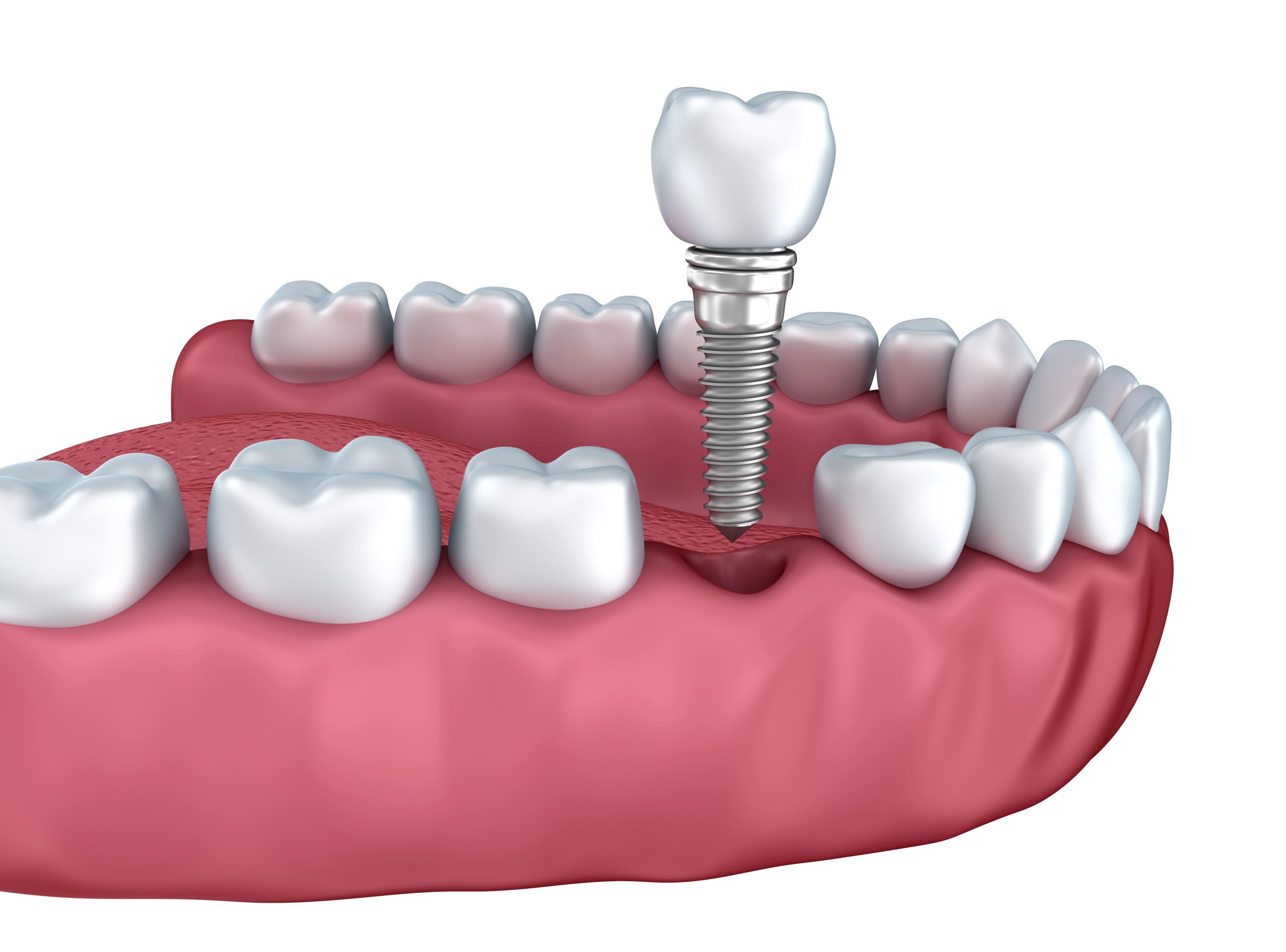 Dental Crown Without Metal: Aesthetic Solutions for a Seamless Smile