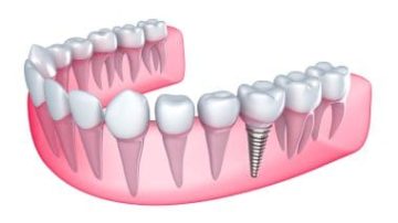 Affordable Dental Crown: Long-Lasting Restoration That Fits Your Budget