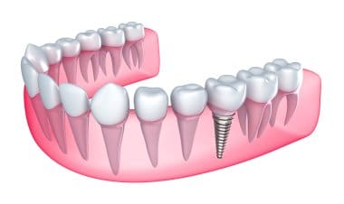 Affordable Dental Crown: Long-Lasting Restoration That Fits Your Budget