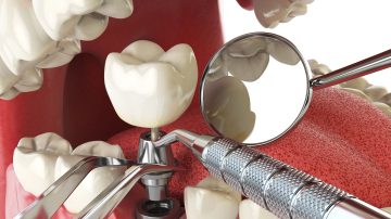 Full Mouth Dental Implants: Complete Smile Transformation
