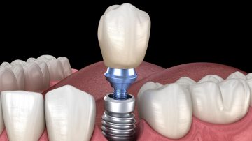 Dental Implant for Missing Teeth: A Permanent, Seamless Solution