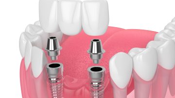 Dental Implant Specialists in Norwood: Expertise You Can Trust