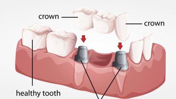 Affordable Dental Implant Solutions: Quality Restorations Within Reach
