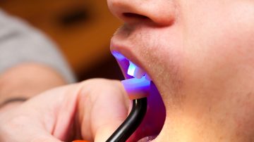 Cosmetic Tooth Bonding Price Guide: What to Expect Before Treatment