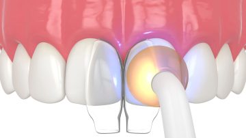 Cosmetic Tooth Bonding Reviews: Real Patient Experiences