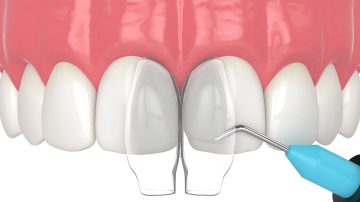 Cosmetic Tooth Bonding Smile Makeover: Subtle Enhancements That Shine