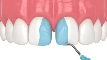 Cosmetic Tooth Bonding Longevity: How Long Will Your Results Last?
