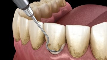 Scaling and Root Planing Aftercare: Ensuring a Healthy Recovery