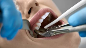 Risks of Tooth Extraction: What to Be Aware Of