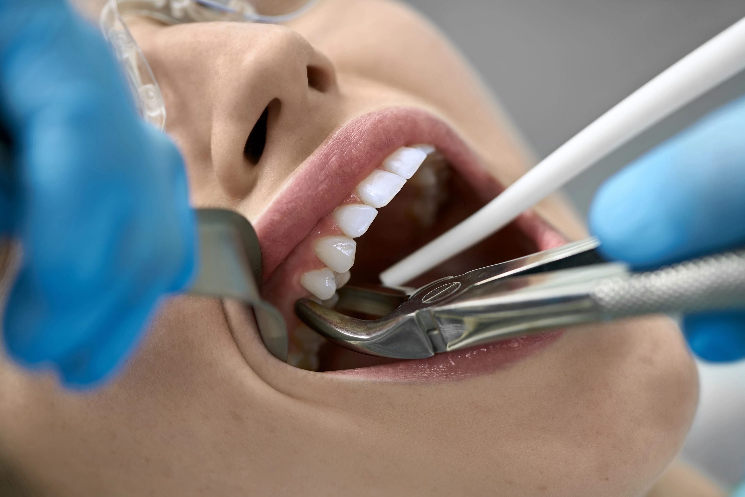 Risks of Tooth Extraction: What to Be Aware Of