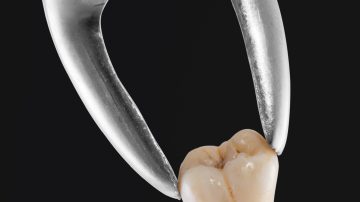 Simple Tooth Extraction Guide: A Step-by-Step Overview