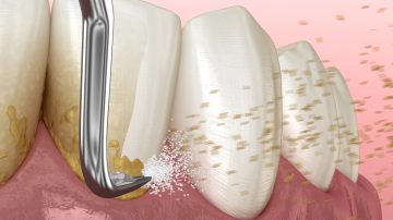 Scaling and Root Planing for Gum Disease: Effective Treatment for Healthier Gums