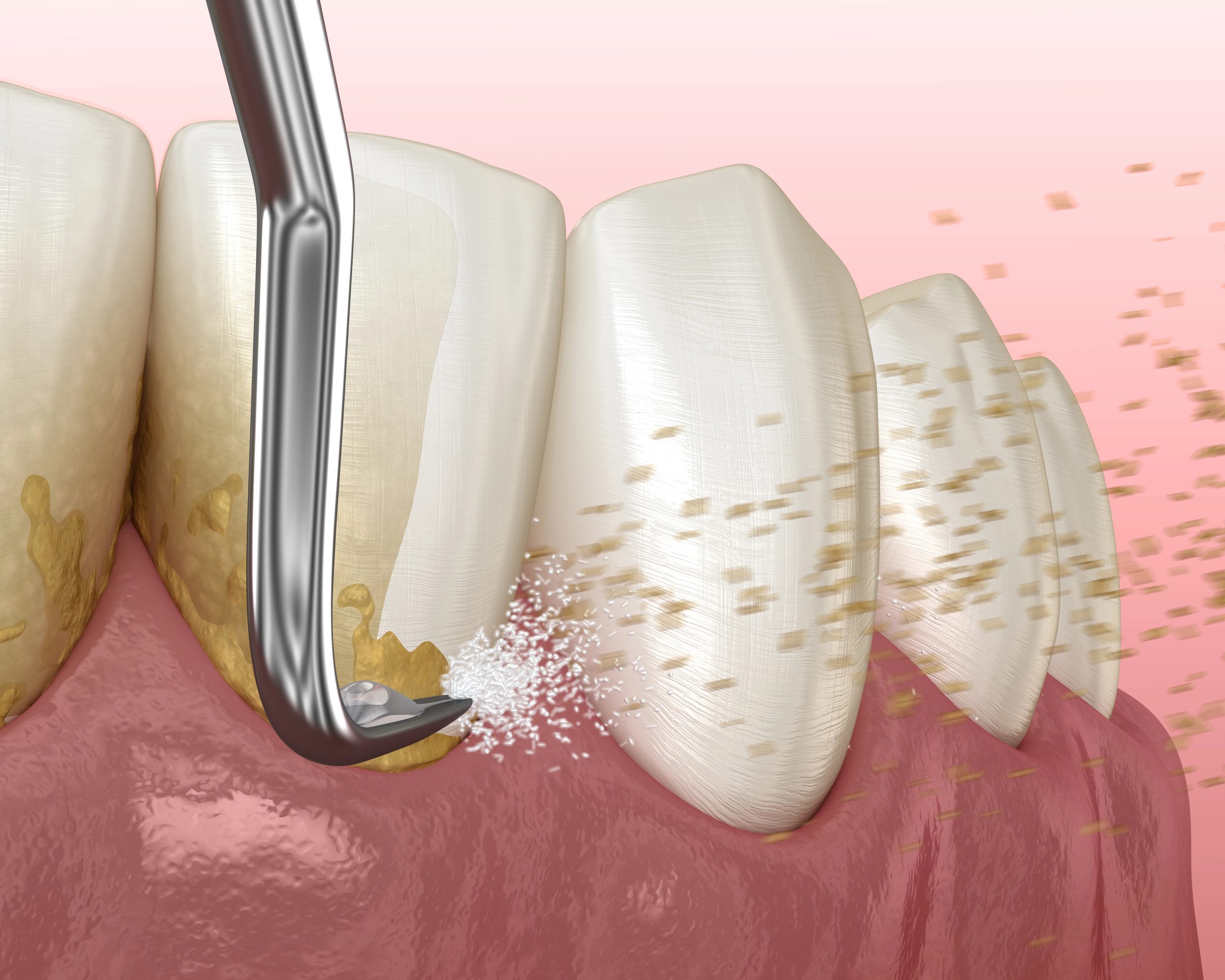 Scaling and Root Planing for Gum Disease: Effective Treatment for Healthier Gums
