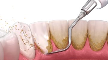 Benefits of Scaling and Root Planing: Why Your Gums Will Thank You