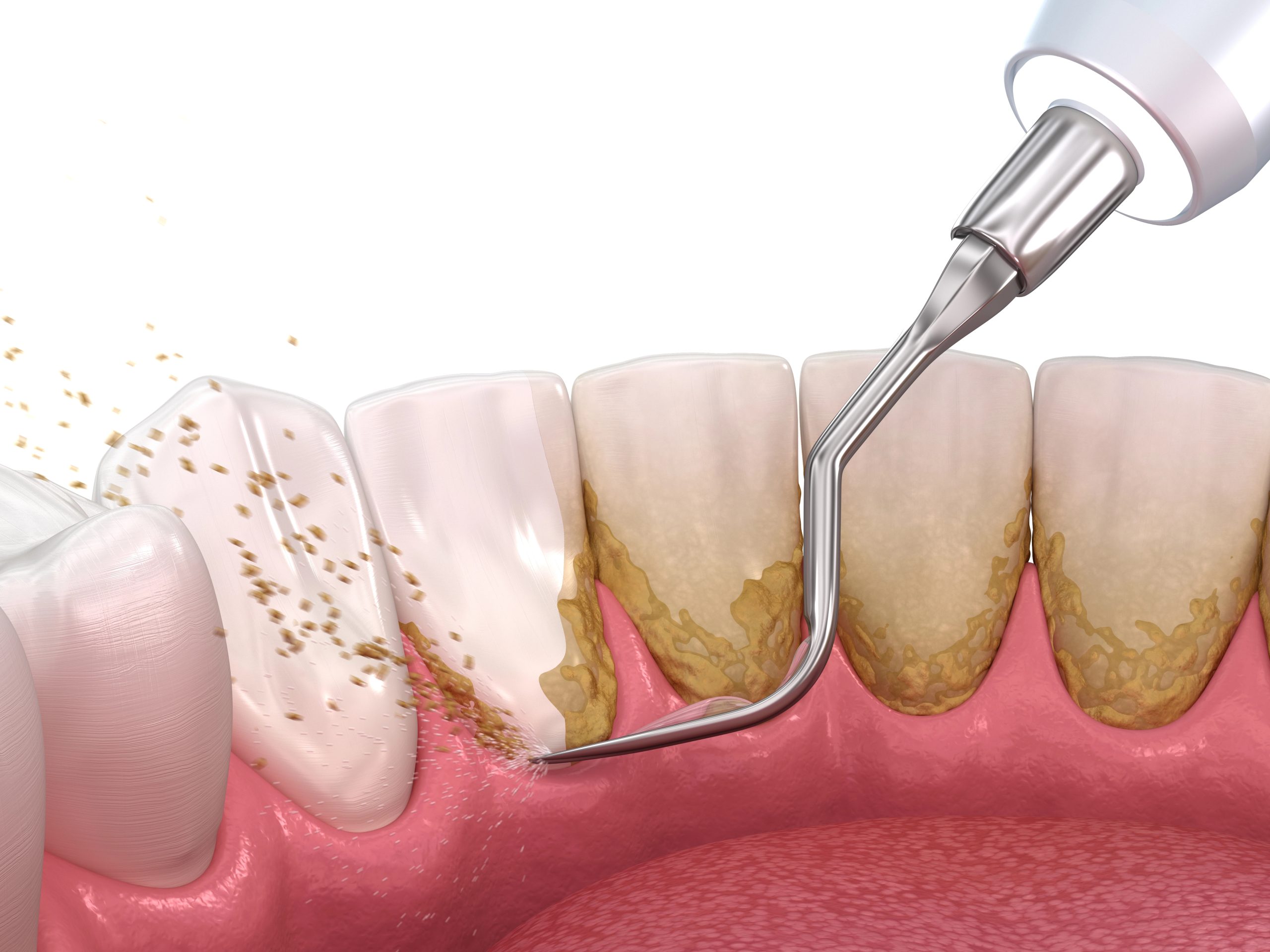 Benefits of Scaling and Root Planing: Why Your Gums Will Thank You