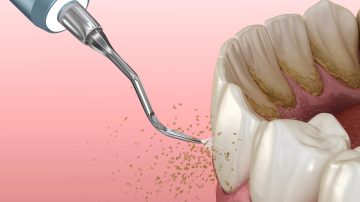 Scaling and Root Planing Cost: Factors That Determine the Price