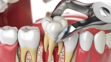 When Tooth Extraction Is Necessary: Signs You Shouldn’t Ignore