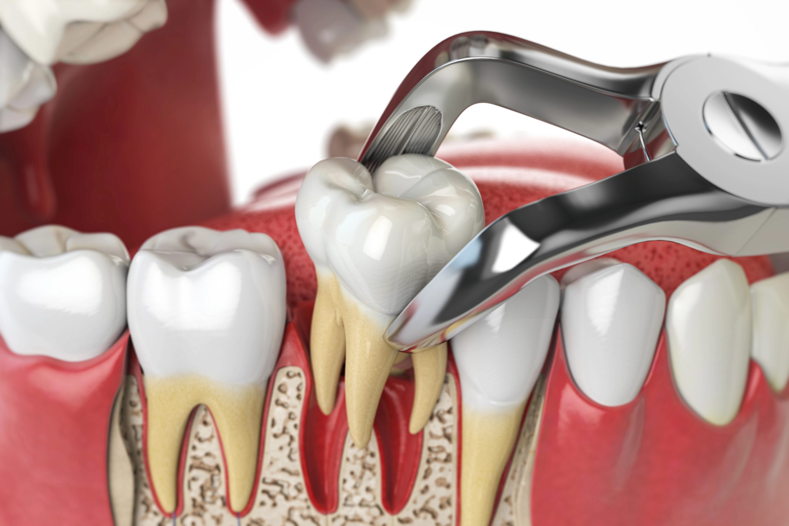 When Tooth Extraction Is Necessary: Signs You Shouldn’t Ignore