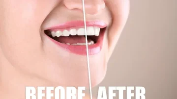 Unveiling the Truth: Top 5 Myths About Gum Contouring Debunked