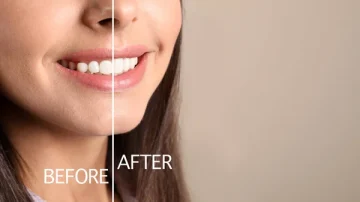 The Art of Gum Contouring for Transforming Smiles with Precision