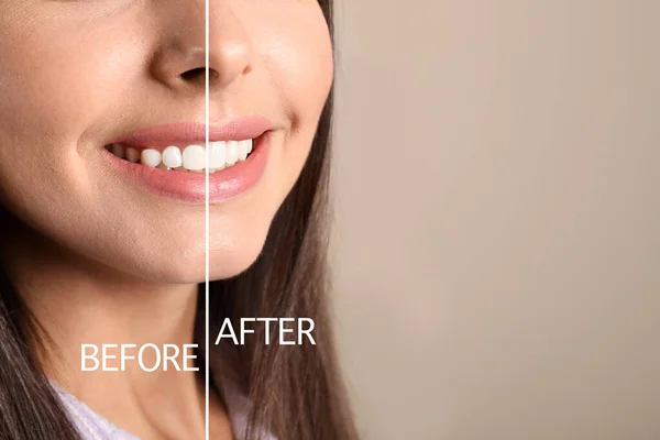 The Art of Gum Contouring for Transforming Smiles with Precision