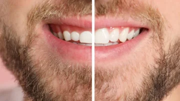 Top 5 Essential Questions to Ask Your Dentist About Gum Contouring for Optimal Results