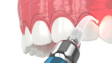 Discover the Surprising Link Between Gum Contouring, Gum Health, and Overall Wellness