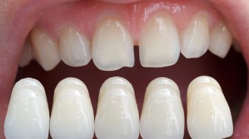 The Ultimate Guide to Choosing the Perfect Shade for Your Dental Veneers