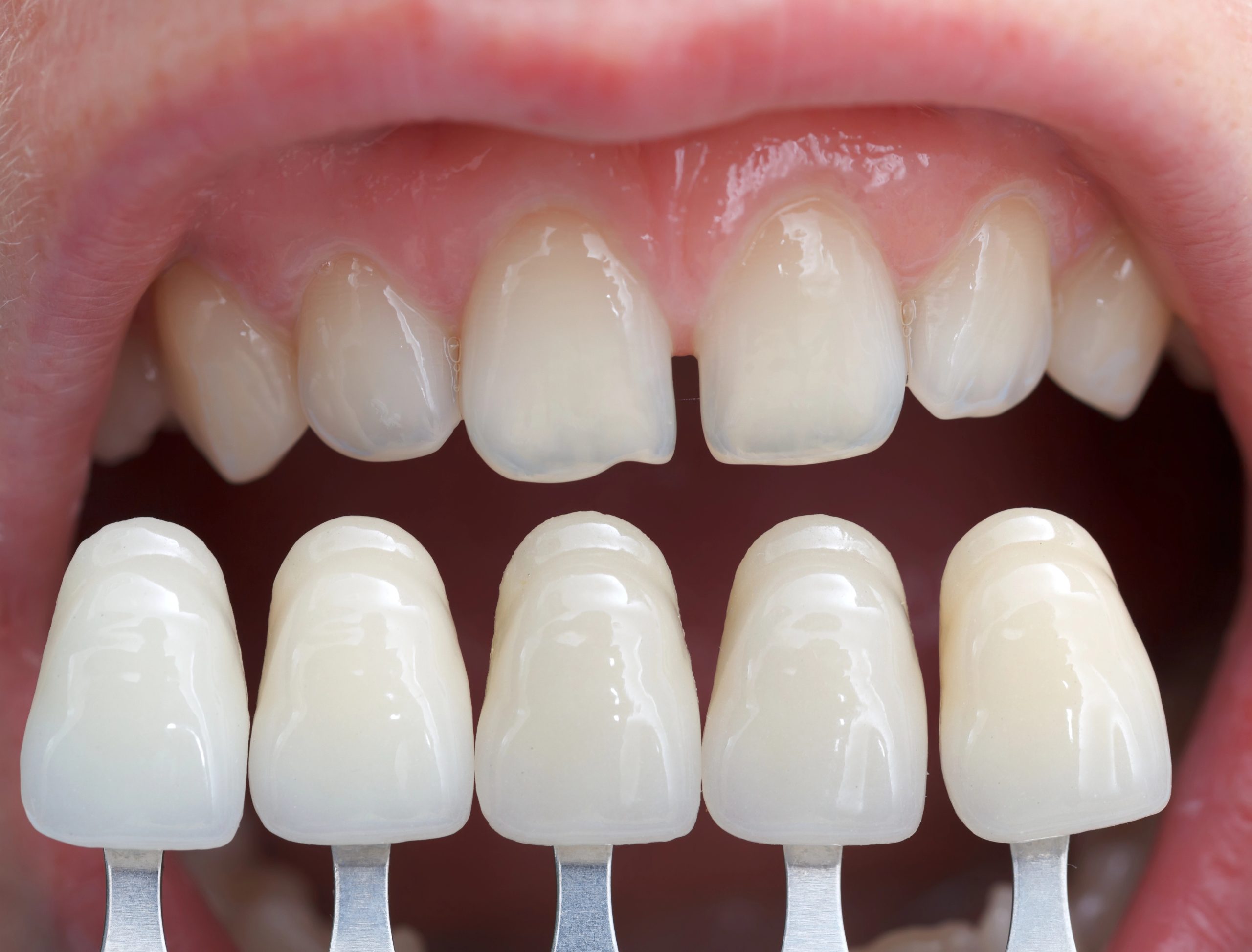 The Ultimate Guide to Choosing the Perfect Shade for Your Dental Veneers