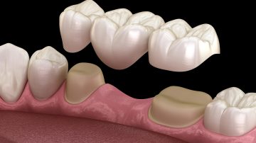 Discover the Art of Dental Bridges and Transform Your Smile One Tooth at a Time