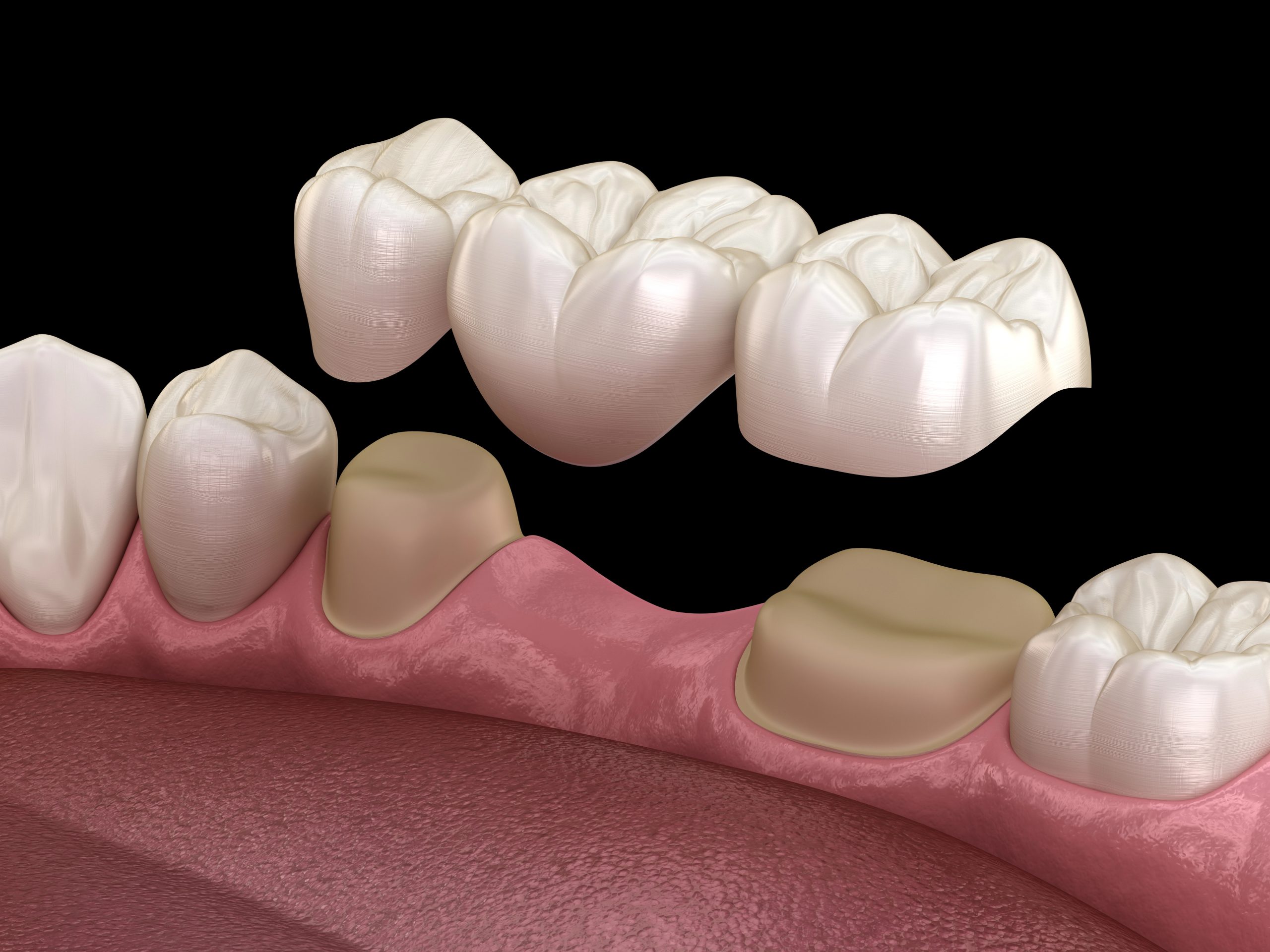 Discover the Art of Dental Bridges and Transform Your Smile One Tooth at a Time