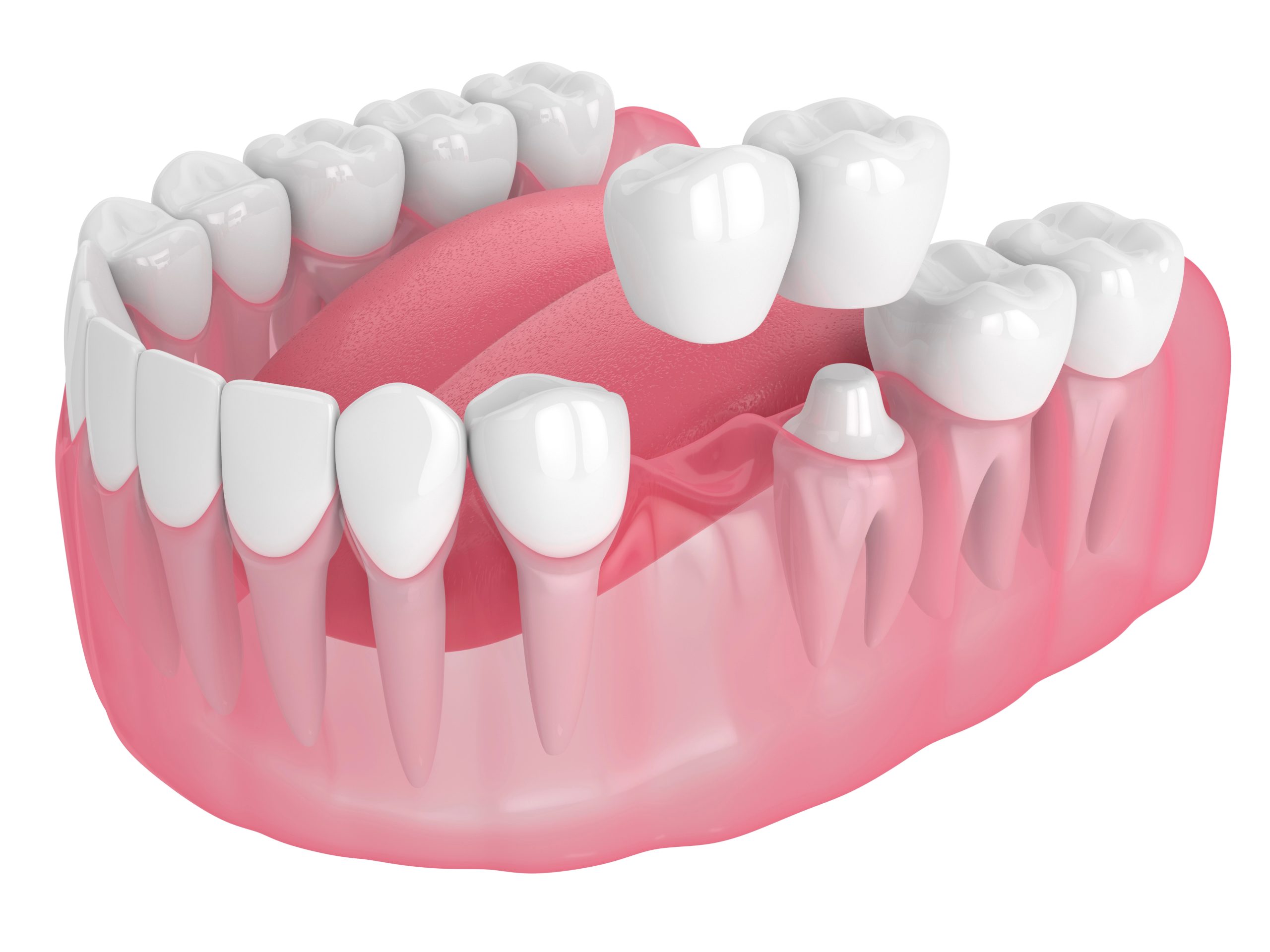 Discover the Best Solution for Missing Teeth with Dental Bridges Norwood: A Comprehensive Guide to Dental Bridges vs. Implants