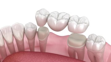Top 5 Essential Questions to Ask Your Dentist Before Getting Dental Bridges Norwood