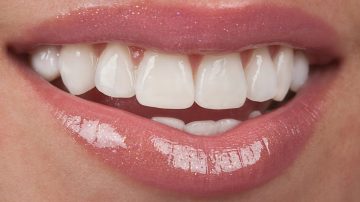 Essential Maintenance Tips for Longevity of Your Dental Veneers Norwood